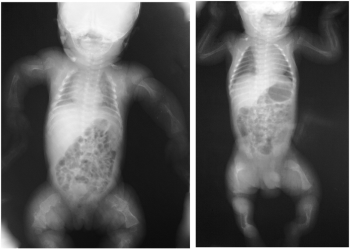 Achondroplasia - RadRounds Radiology Network