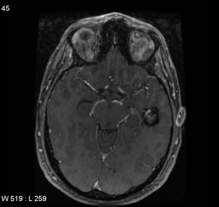 Cavernous Malformation - radRounds Radiology Network