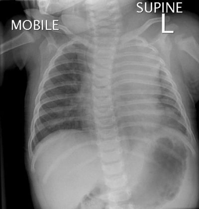 Cystic Hygroma - radRounds Radiology Network