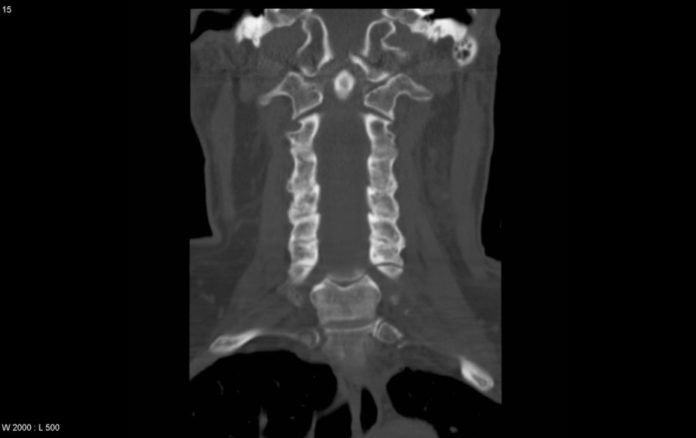 Occipital Condyle Fracture Radrounds Radiology Network 3019