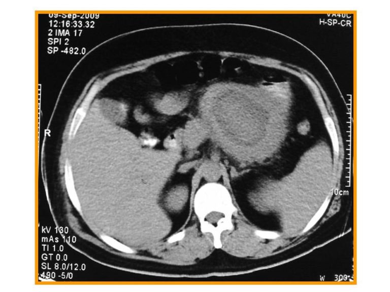 Pancreatic lymphoma - radRounds Radiology Network