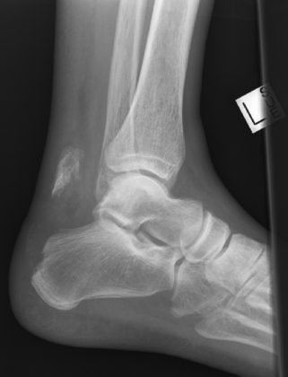 Calcaneal Tuberosity Avulsion Fracture - radRounds Radiology Network