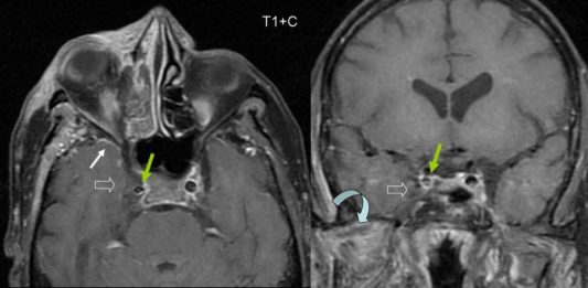 images cavernous sinus        
        <figure class=