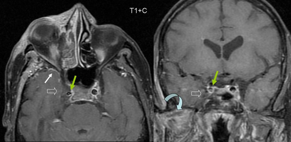 Cavernous Sinus Thrombosis Radrounds Radiology Network