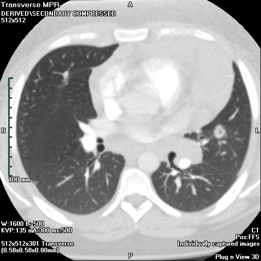 Cavitating Pulmonary Lymphoma Radrounds Radiology Network