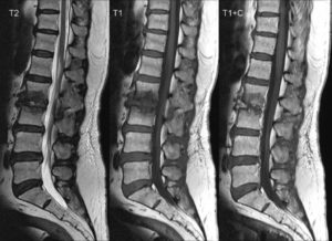 Pyogenic Spondylodiskitis - radRounds Radiology Network