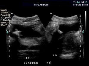 Urinary Bladder Calculus - radRounds Radiology Network