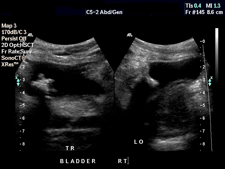 Urinary Bladder Calculus - RadRounds Radiology Network