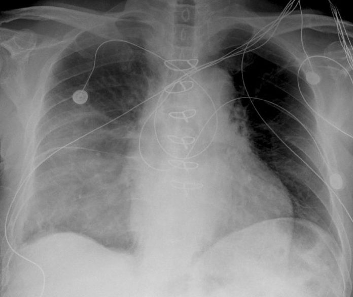 Malignant Thymoma - radRounds Radiology Network