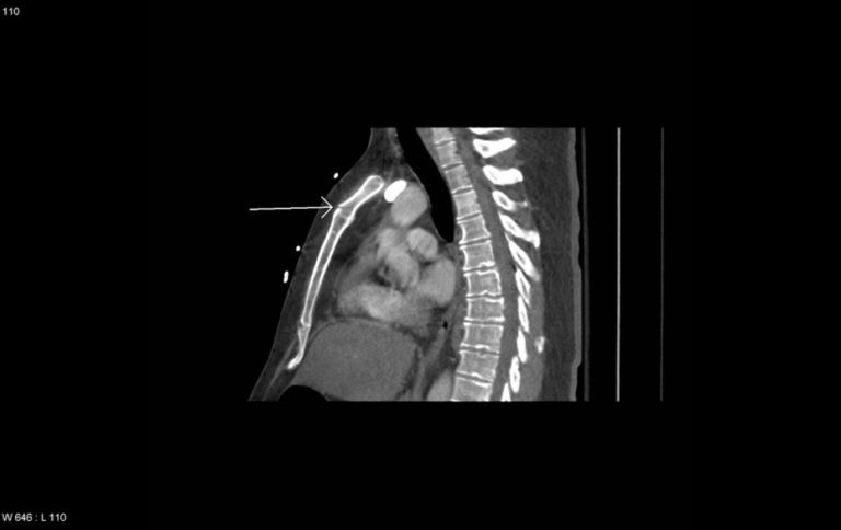 Fracture Of Manubrium Radrounds Radiology Network