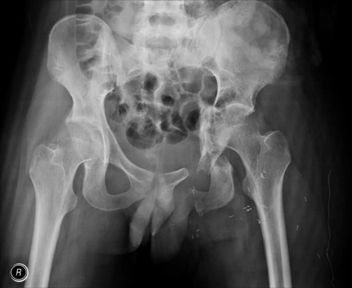 fracture-of-superior-and-inferior-pubic-rami-ischium-and-acetabulum