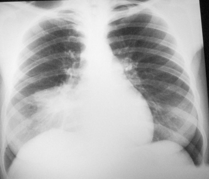 Right Middle Lobe Consolidation - radRounds Radiology Network