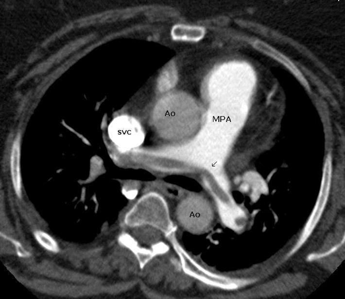 Saddle Pulmonary Embolus Radrounds Radiology Network 8653