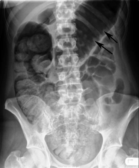 Toxic Megacolon - radRounds Radiology Network