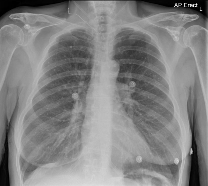 Healed Varicella Pneumonia - radRounds Radiology Network