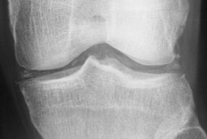 Chondrocalcinosis - CPPD as seen on Knee X-Ray - radRounds Radiology ...