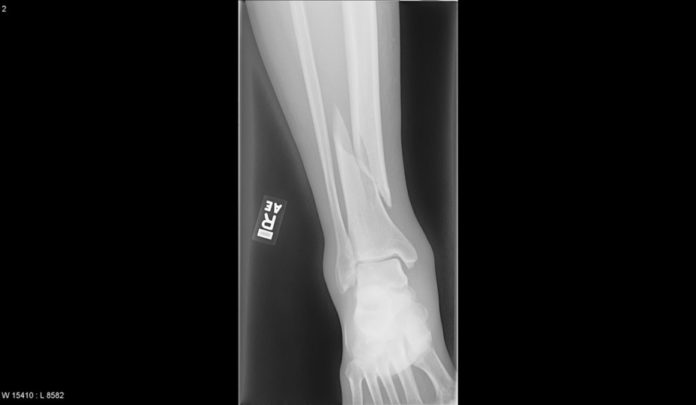 Fracture of the Tibia - radRounds Radiology Network