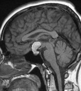 Craniopharyngioma - radRounds Radiology Network