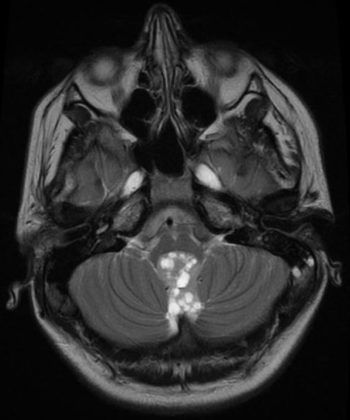 Cerebral Ependymoma - radRounds Radiology Network