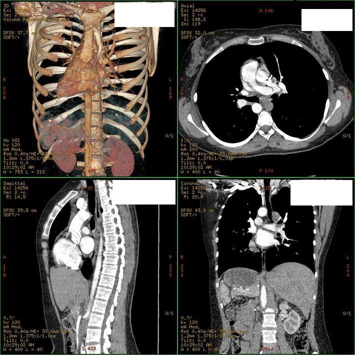 Situs Inversus Ct Radrounds Radiology Network