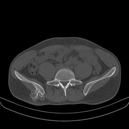 Osteochondroma - radRounds Radiology Network