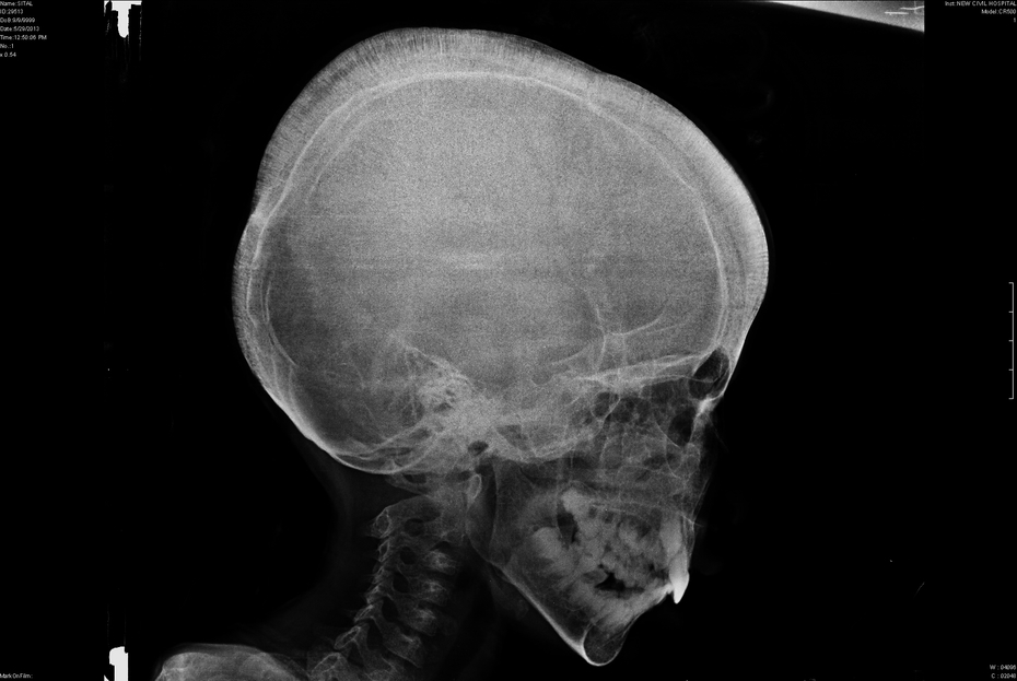 Hair on End Appearance of Skull - Thalassemia - radRounds Radiology Network