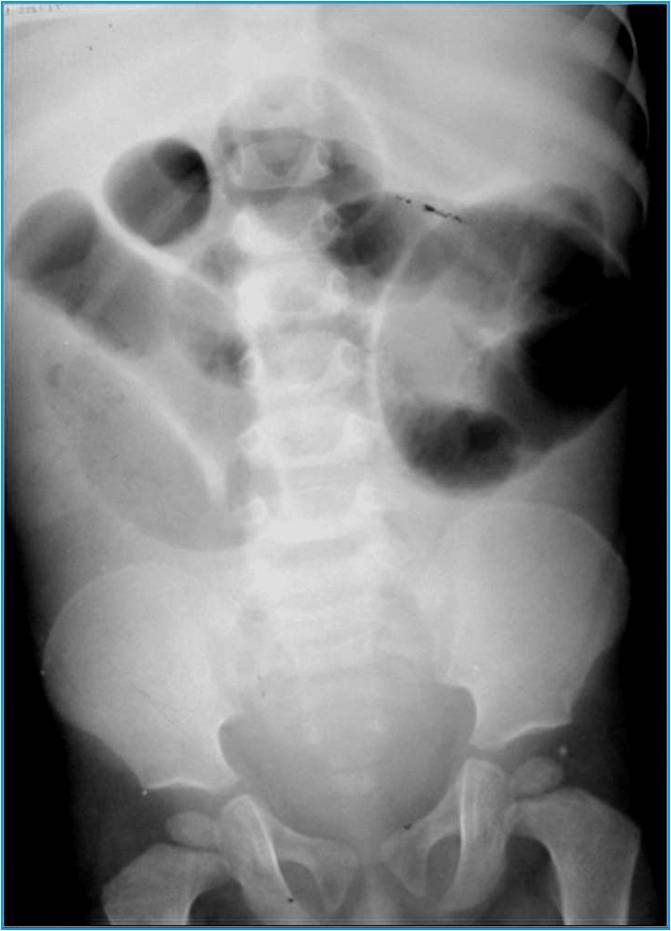 Small bowel volvulus - radRounds Radiology Network