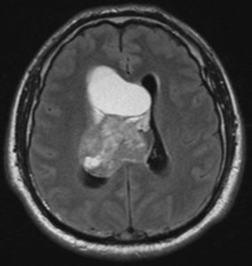 Central Neurocytoma - radRounds Radiology Network