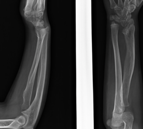 Madelung Deformity - radRounds Radiology Network